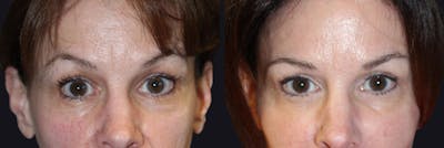 Botox Before & After Gallery - Patient 177904621 - Image 1