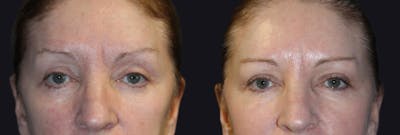 Botox Before & After Gallery - Patient 177904620 - Image 1