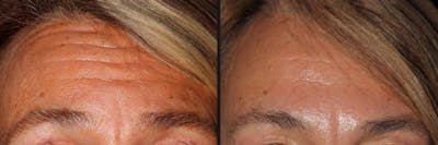 Botox Before & After Gallery - Patient 177904616 - Image 1
