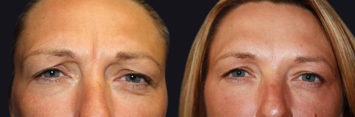 Botox Before & After Gallery - Patient 177904615 - Image 1