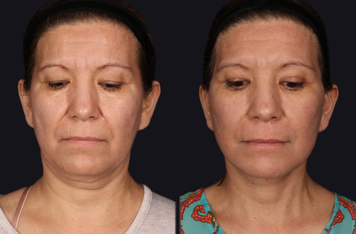 Deep Plane Facelift Before & After Gallery - Patient 177619131 - Image 8
