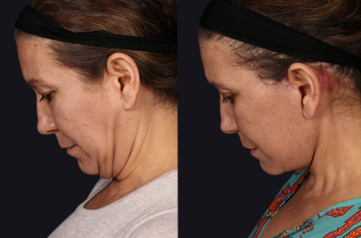 Deep Plane Facelift Before & After Gallery - Patient 177619131 - Image 7
