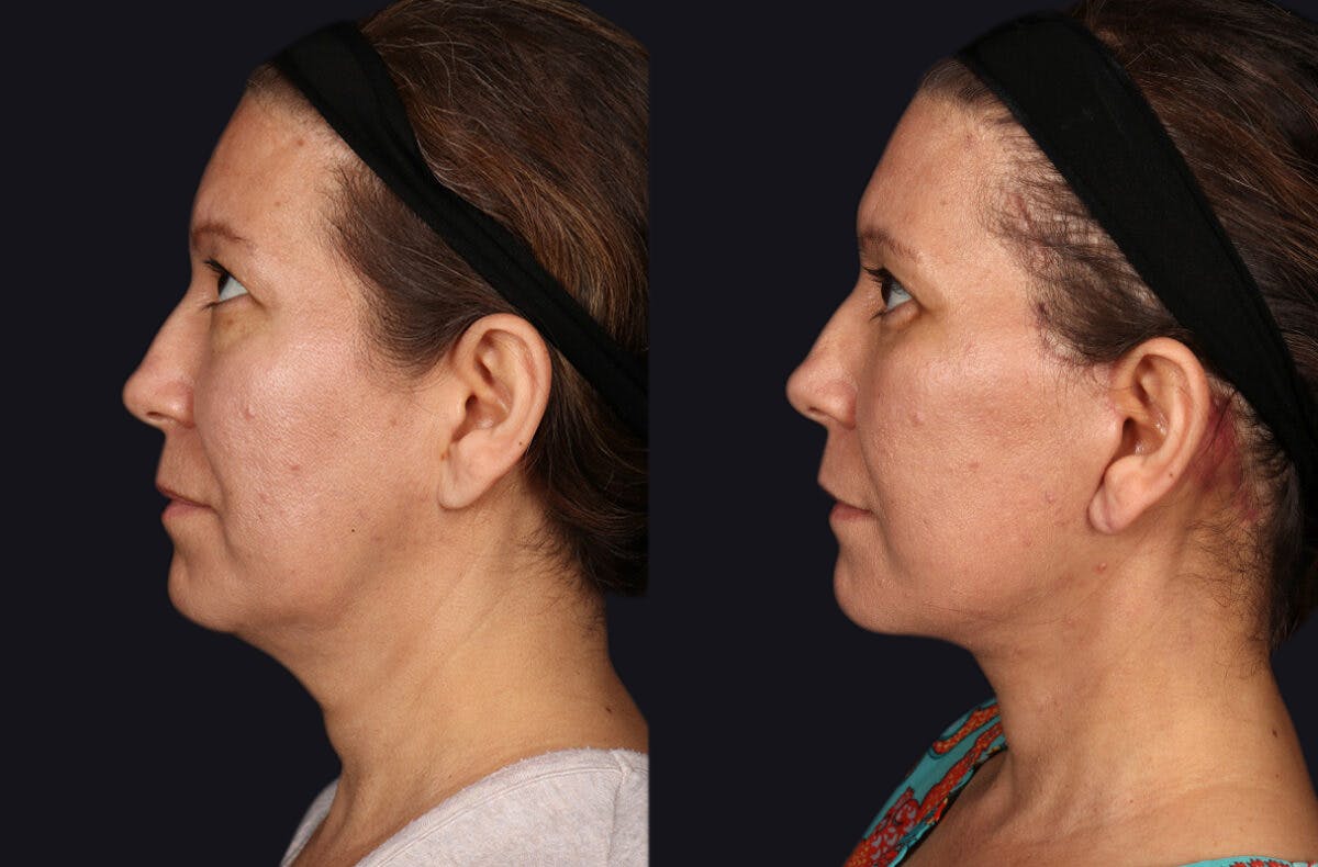 Deep Plane Facelift Before & After Gallery - Patient 177619131 - Image 1