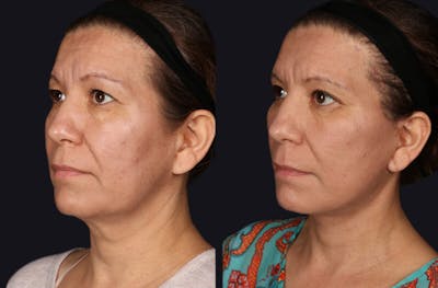 Facelift LP (Branded - 3 Doctors) Before & After Gallery - Patient 245529 - Image 1