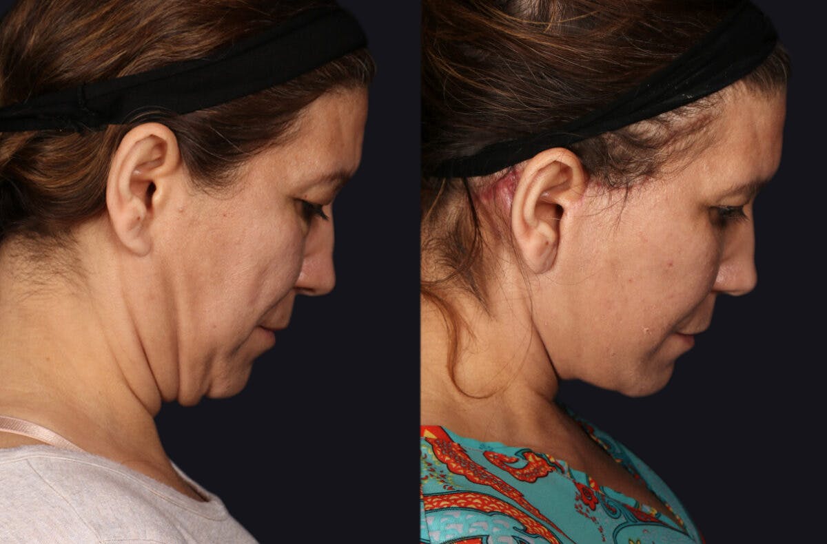 Deep Plane Facelift Before & After Gallery - Patient 177619131 - Image 5