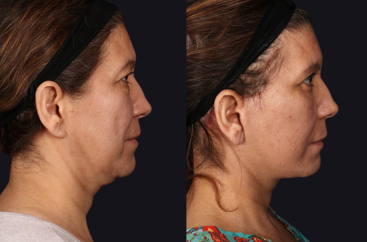 Deep Plane Facelift Before & After Gallery - Patient 177619131 - Image 4