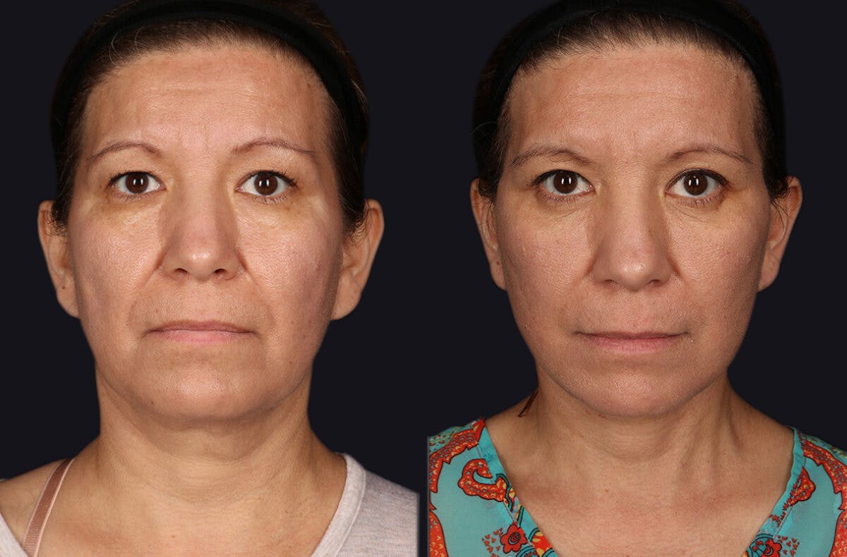 Deep Plane Facelift Before & After Gallery - Patient 177619131 - Image 2