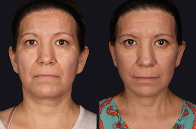 Deep Plane Facelift Before & After Gallery - Patient 177619131 - Image 1