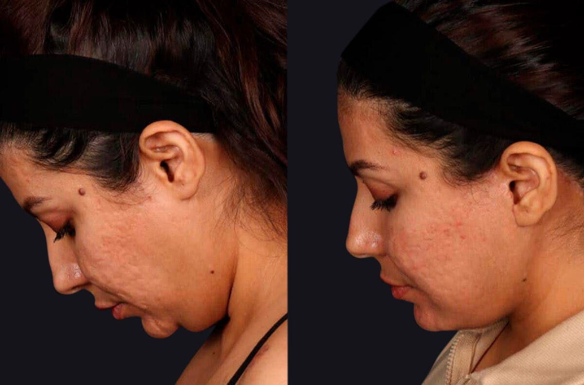 Deep Plane Facelift Before & After Gallery - Patient 177619127 - Image 7
