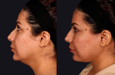 Deep Plane Facelift Before & After Gallery - Patient 177619127 - Image 1
