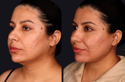 Deep Plane Facelift Before & After Gallery - Patient 177619127 - Image 1