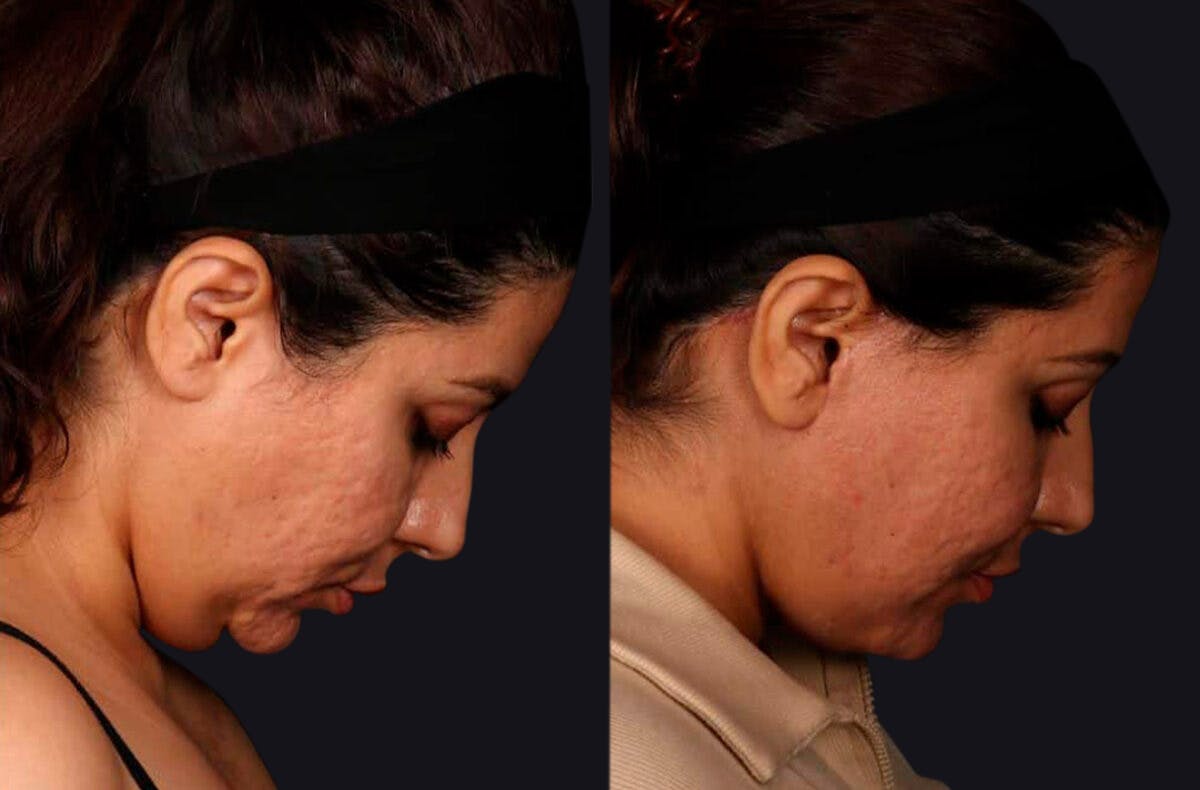 Deep Plane Facelift Before & After Gallery - Patient 177619127 - Image 5
