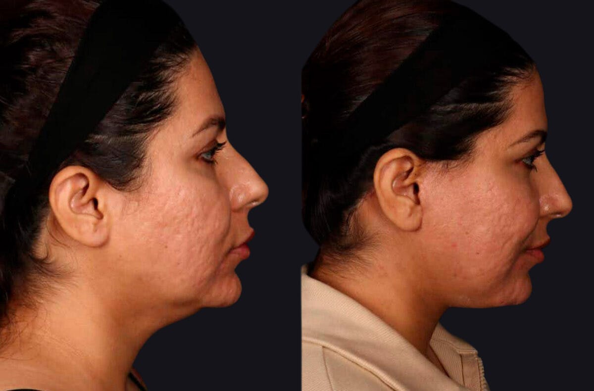 Deep Plane Facelift Before & After Gallery - Patient 177619127 - Image 4