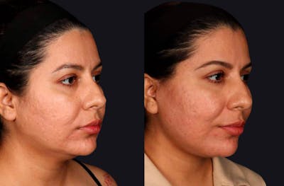 Facelift Before & After Gallery - Patient 189394 - Image 1