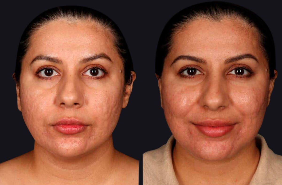 Deep Plane Facelift Before & After Gallery - Patient 177619127 - Image 2