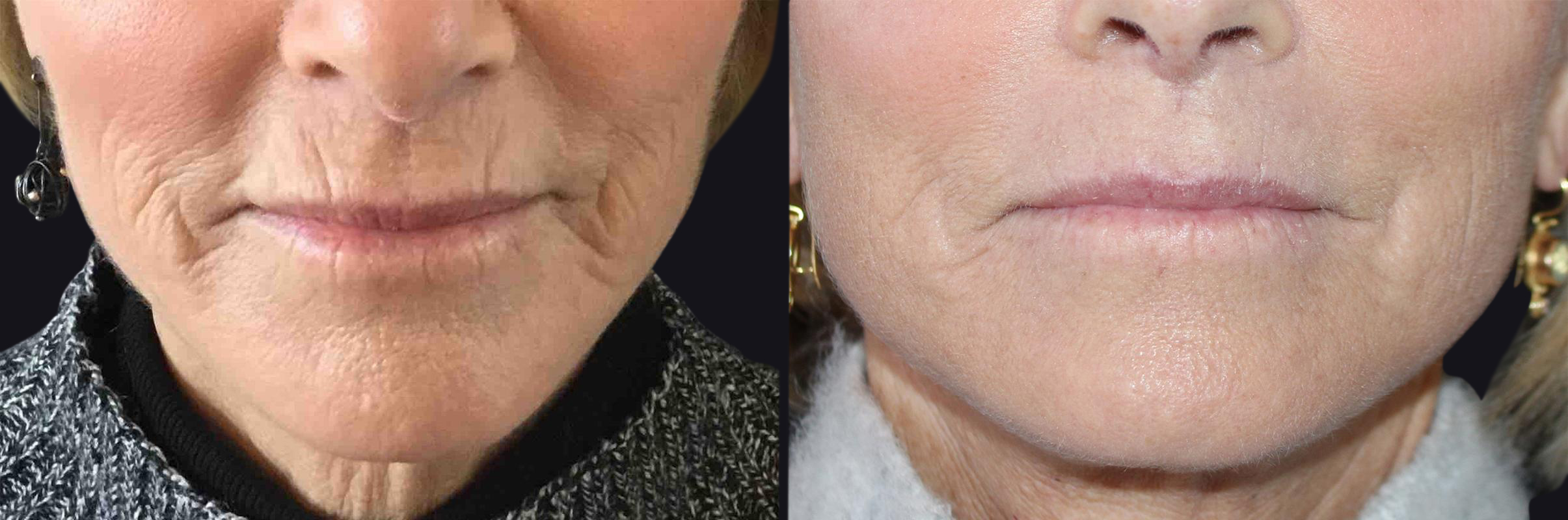 Before and after image of Microneedling