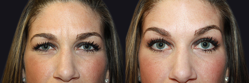 Before and After Injectables Photos in Boston