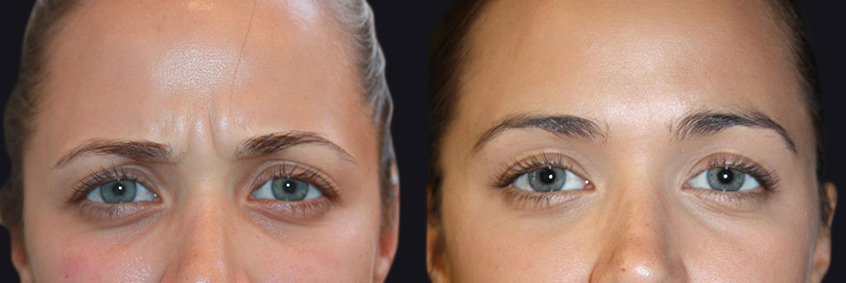 Before and After Injectables Photos in Boston