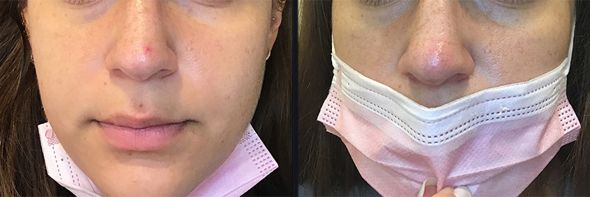 Before and After Skin Rejuvenation Photos in Boston
