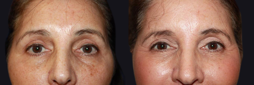 Before and After Skin Rejuvenation Photos in Boston