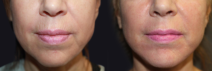 Before and After Micro-Needling Photos in Boston