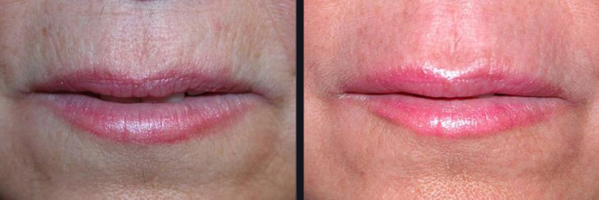 Before and After Micro-Needling Photos in Boston