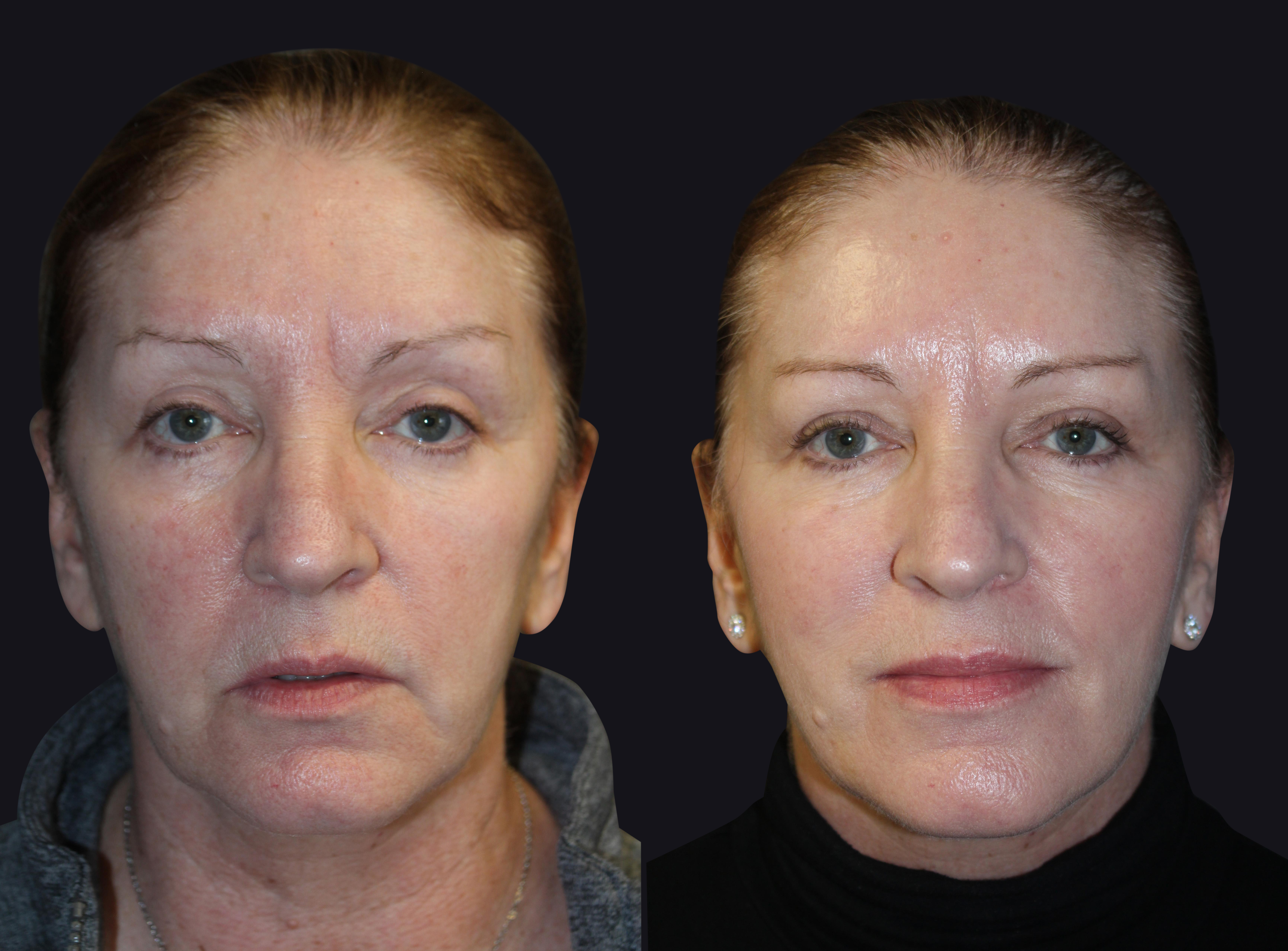 Before and After Dermal Fillers Photos in Boston