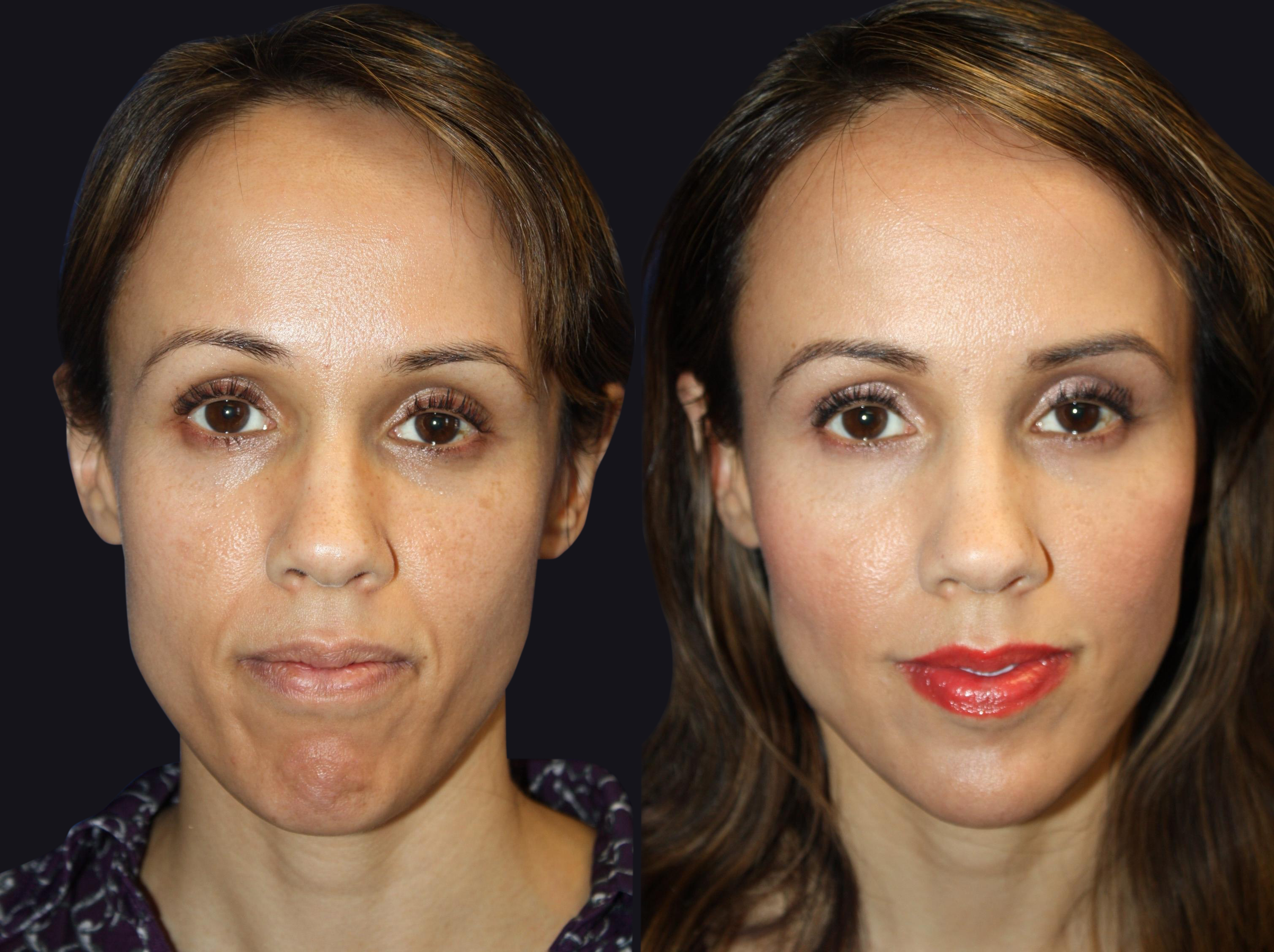 Before and After Dermal Fillers Photos in Boston