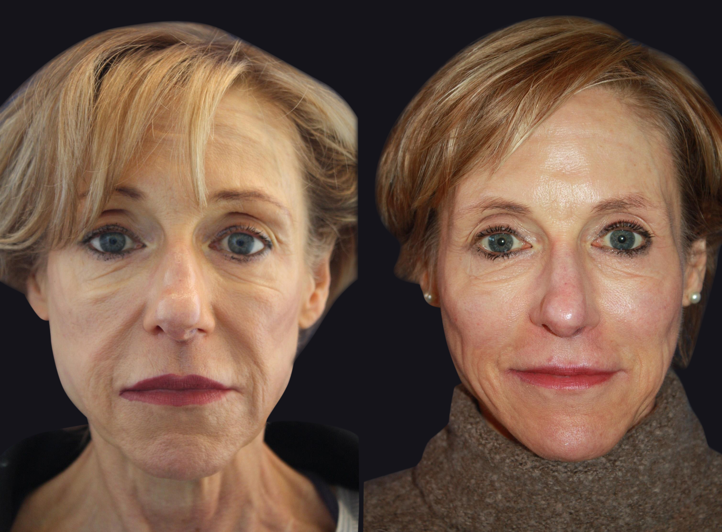 Before and After Dermal Fillers Photos in Boston