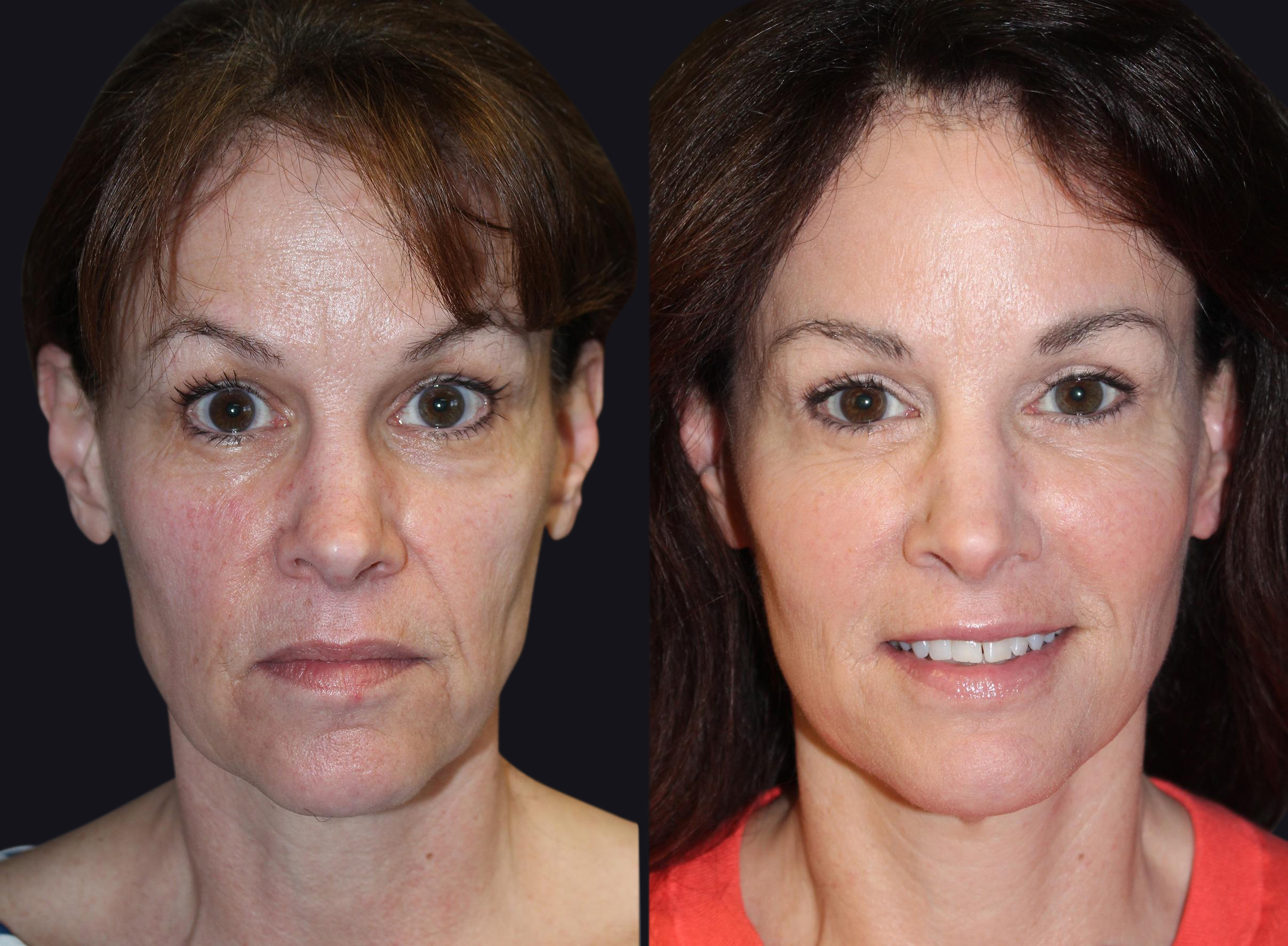 Before and After Dermal Fillers Photos in Boston