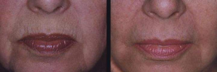 Before and After Collagen Induction Therapy Photos in Boston