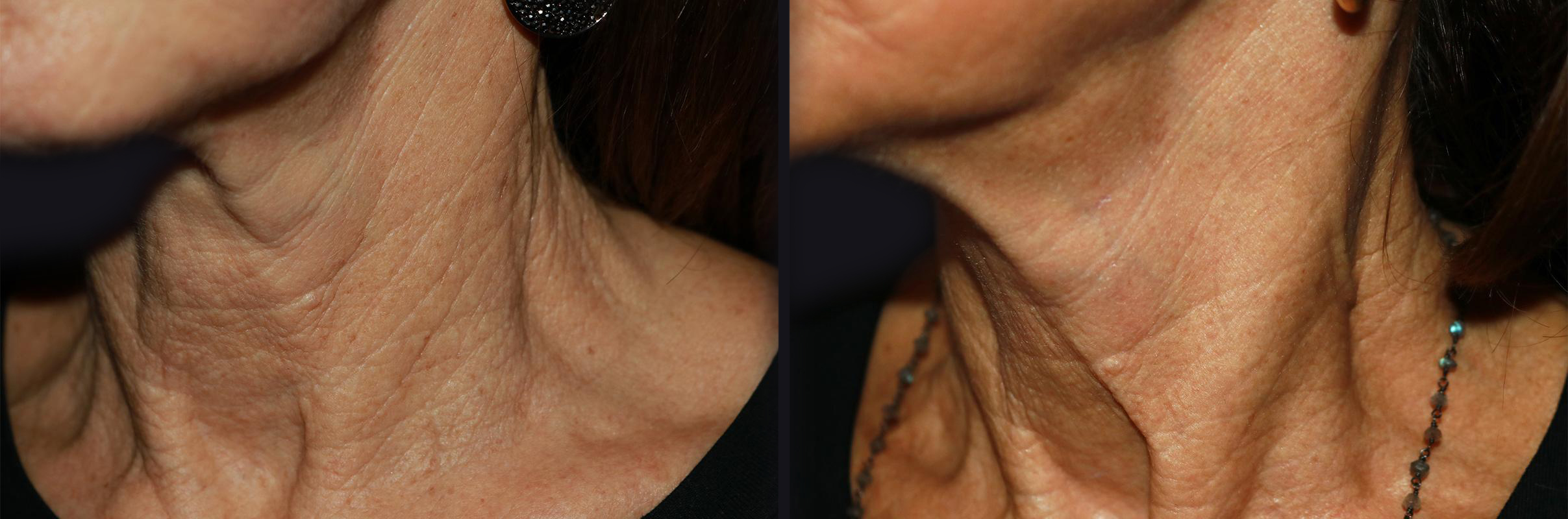 Before and After Collagen Induction Therapy Photos in Boston