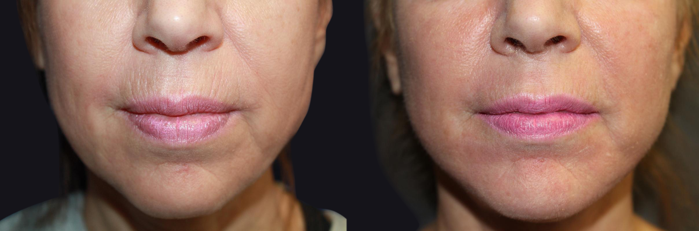 Before and After Collagen Induction Therapy Photos in Boston