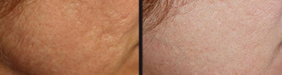 Microneedling Before and after 4