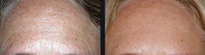 Microneedling Before and after 2