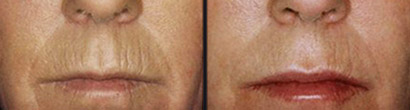 Microneedling Before and after 3
