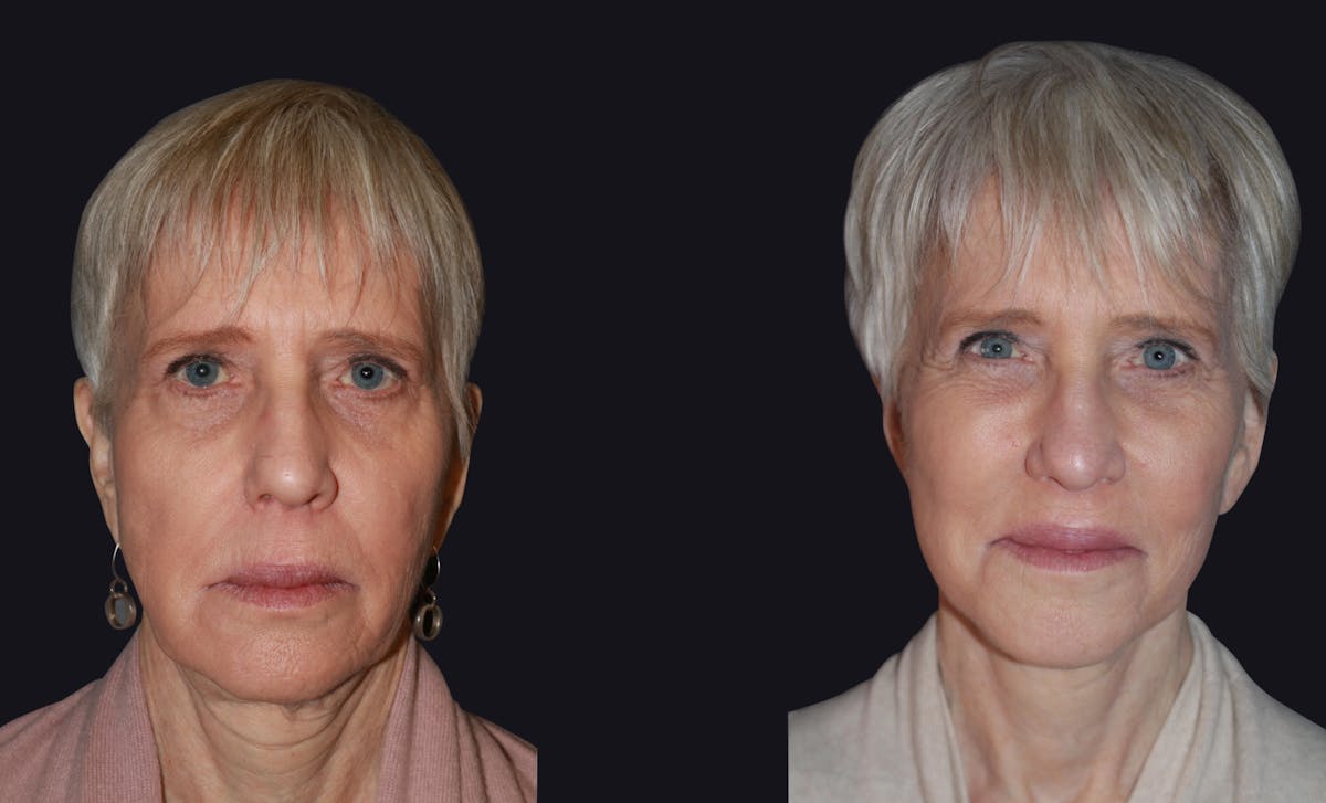 Fat Injections Before & After Gallery - Patient 223898 - Image 1