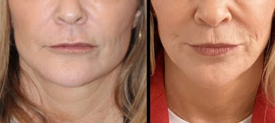 Lip Lift Before & After Gallery - Patient 177905330 - Image 1