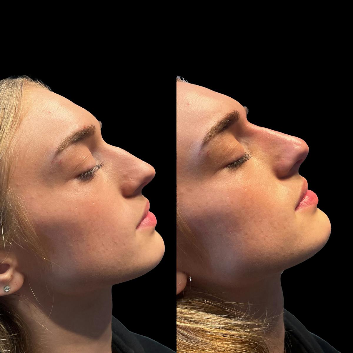 Non Surgical Rhinoplasty Before & After Gallery - Patient 535295 - Image 1