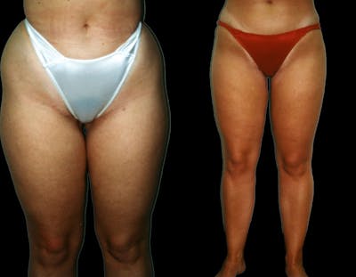 Liposuction Before & After Gallery - Patient 393157 - Image 1