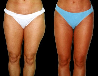 Liposuction Before & After Gallery - Patient 254551 - Image 1