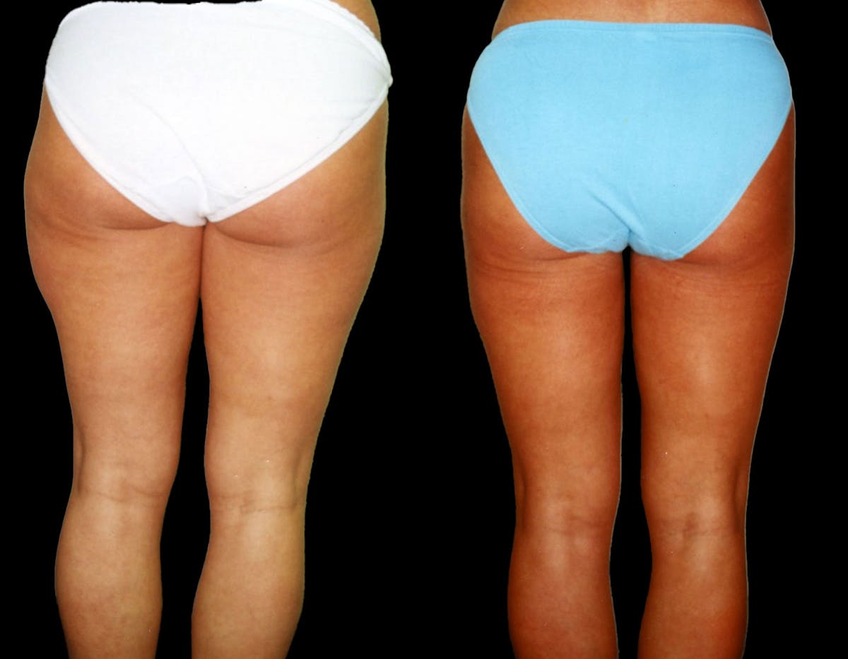 Liposuction Before & After Gallery - Patient 254551 - Image 2