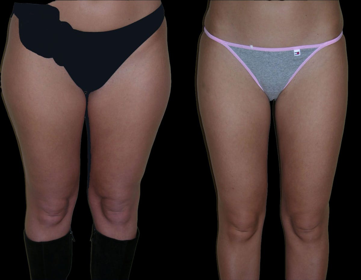 Liposuction Before & After Gallery - Patient 398303 - Image 1