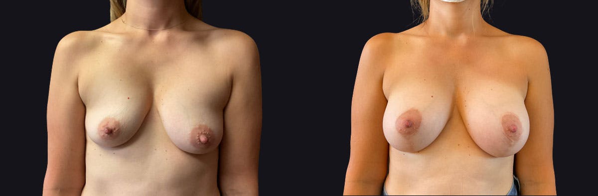 Breast Augmentation Before & After Gallery - Patient 167426 - Image 1