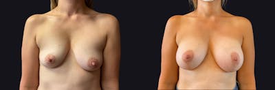 Breast Augmentation Before & After Gallery - Patient 167426 - Image 1