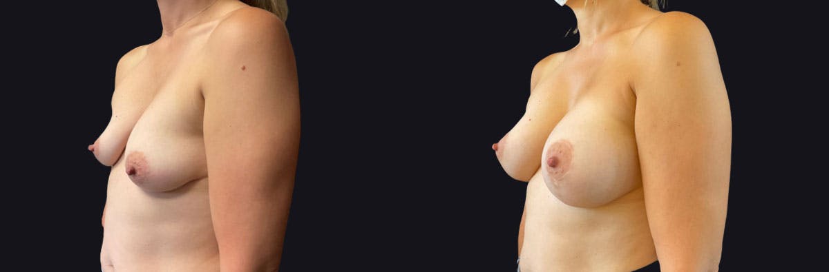 Breast Augmentation Before & After Gallery - Patient 167426 - Image 2