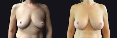 Breast Augmentation Before & After Gallery - Patient 388571 - Image 1
