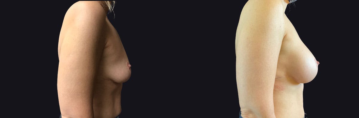 Breast Augmentation Before & After Gallery - Patient 388571 - Image 2