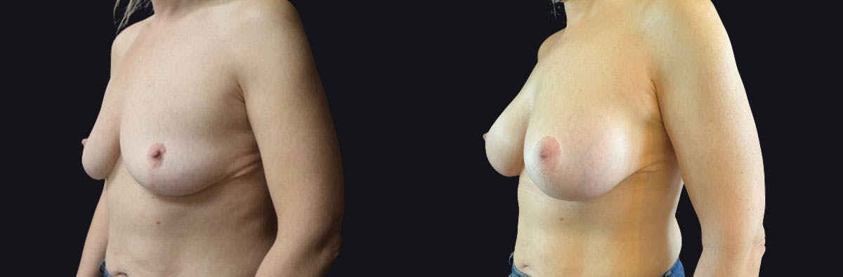 Breast Augmentation Before & After Gallery - Patient 388571 - Image 3