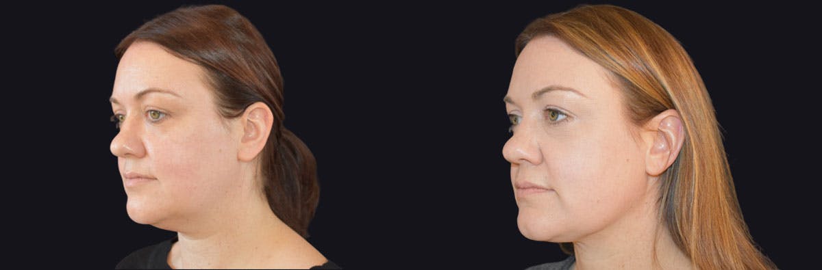 Neck Lift Before & After Gallery - Patient 412644 - Image 2